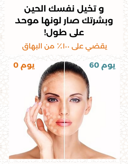 كريم القضاء على البهق